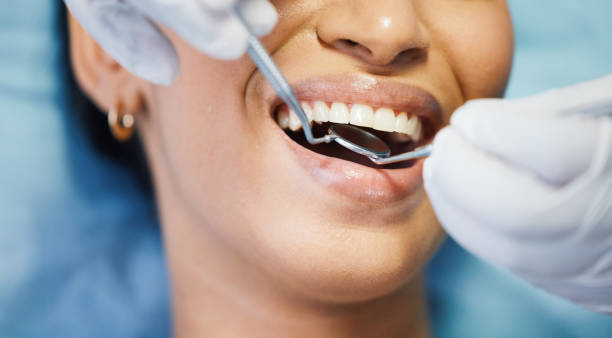 Best Emergency Dentist for Lost Fillings or Crowns in Brier, WA